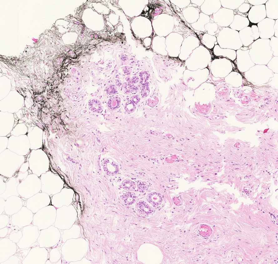 carcinoma ductale invasivum mammae kontroll