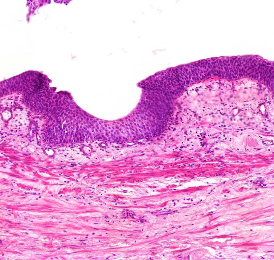 carcinoma transitiocellulare ép pyelon