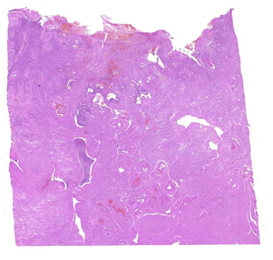 chorionepithelioma