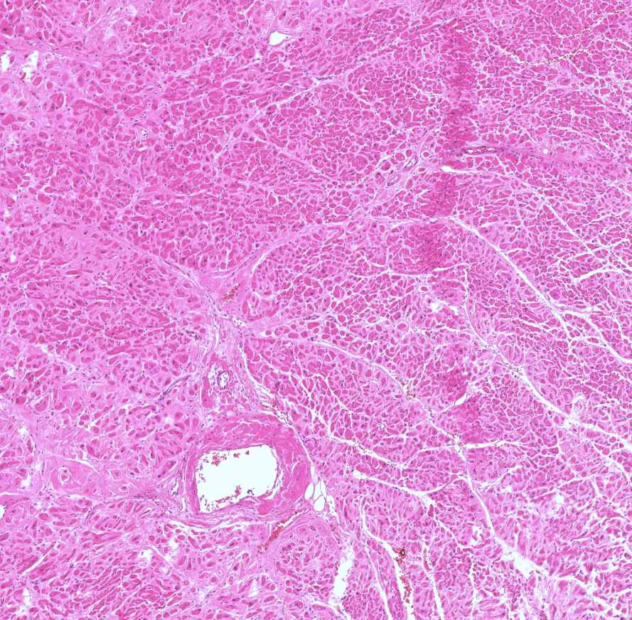 hypertrophias cardiomyopathia KSZ