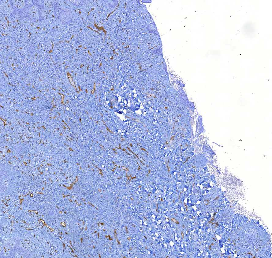 Kaposi sarcoma (CD34)