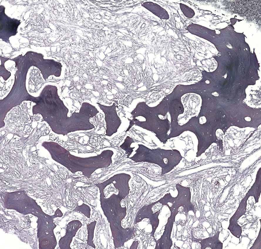 myelofibrosis (reticulin)0