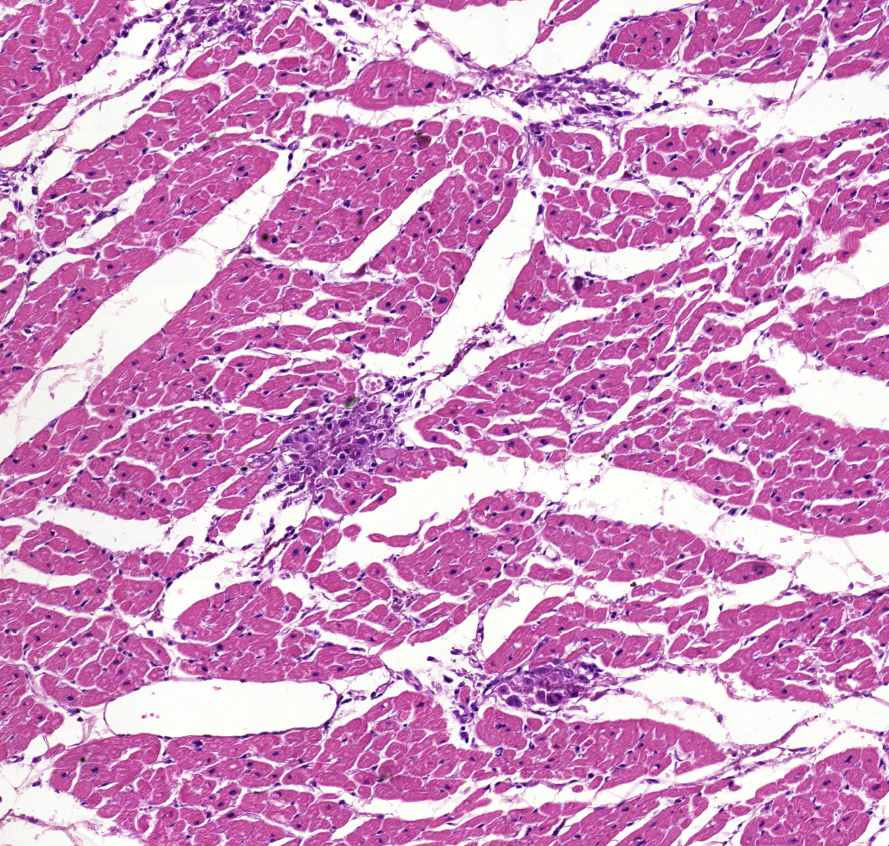 myocarditis rheumatica granulomák