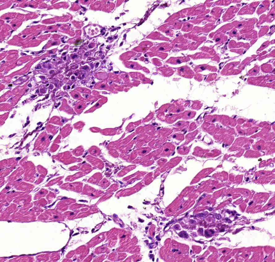 myocarditis rheumatica0