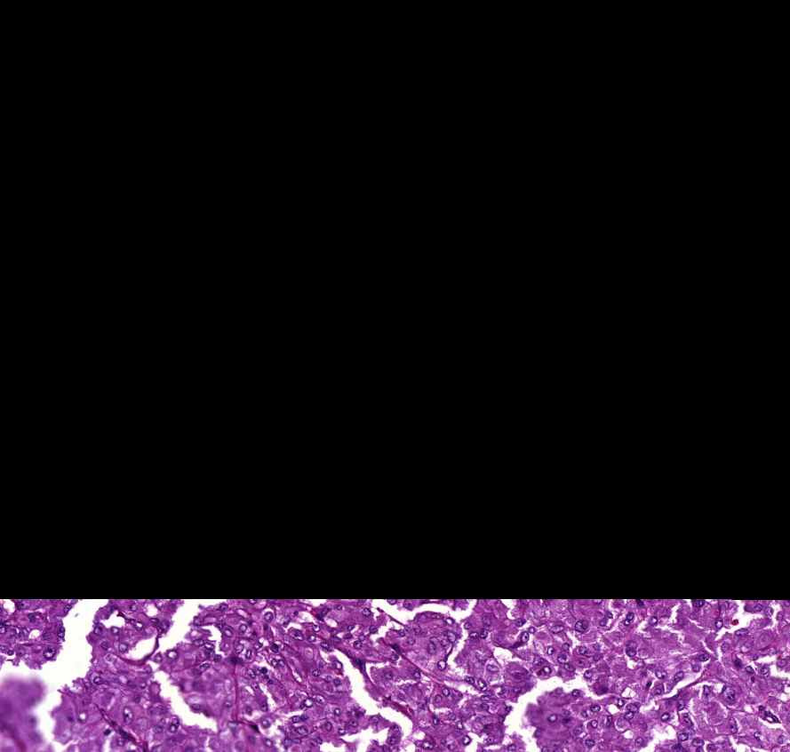 pheochromocytoma0