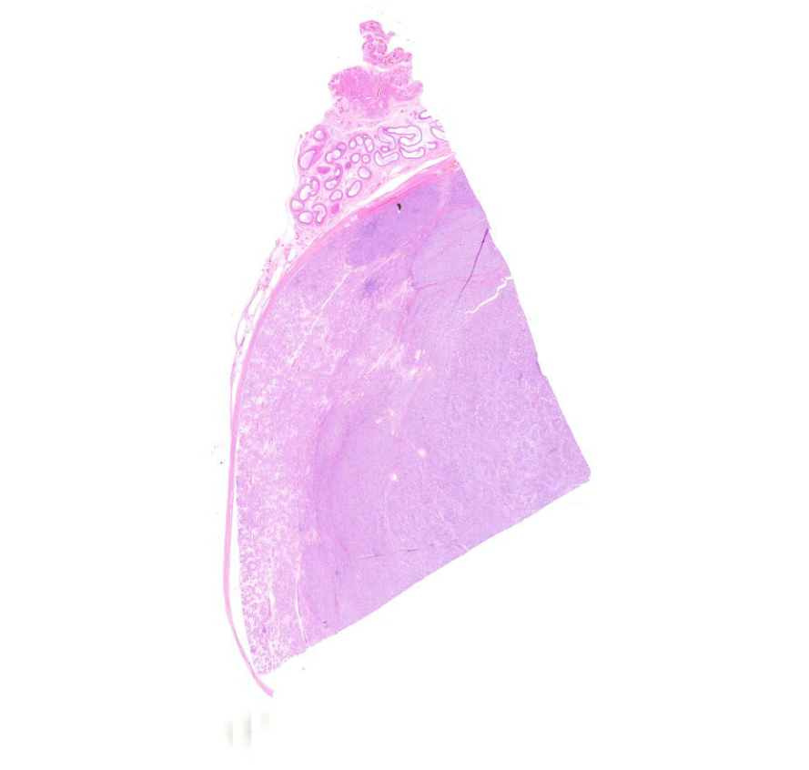 seminoma