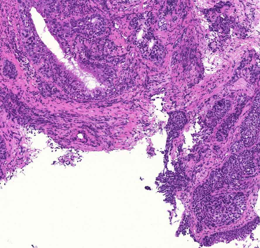 bronchus-metaplasia-dysplasia-carcinomakontroll