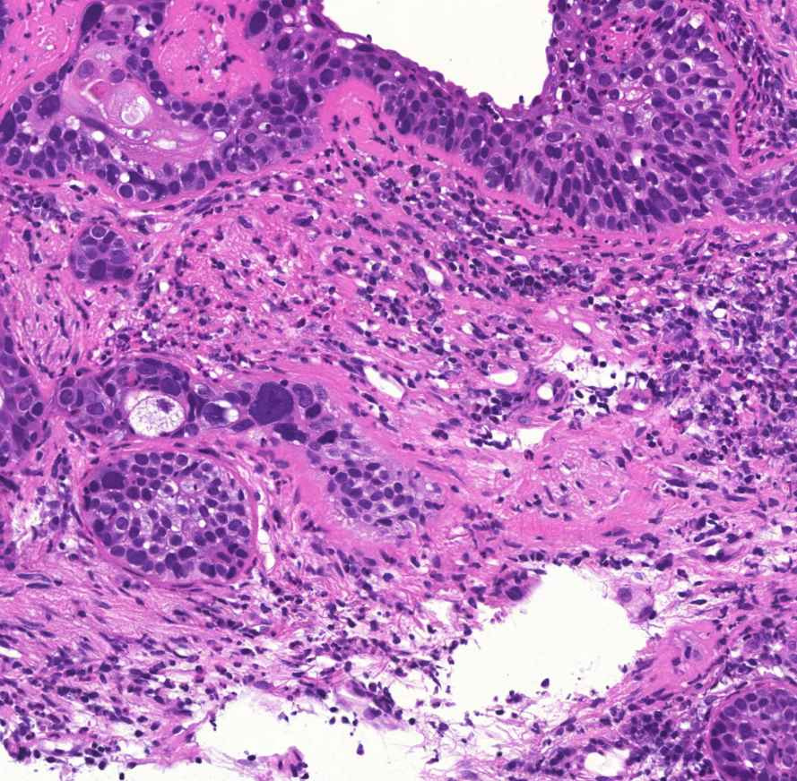 bronchus-metaplasia-dysplasia-carcinomamár rákos, rossz helyen, 