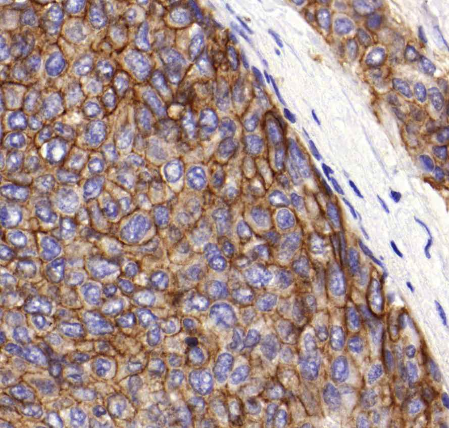 carcinoma ductale invasivum mammae (Her-2)0