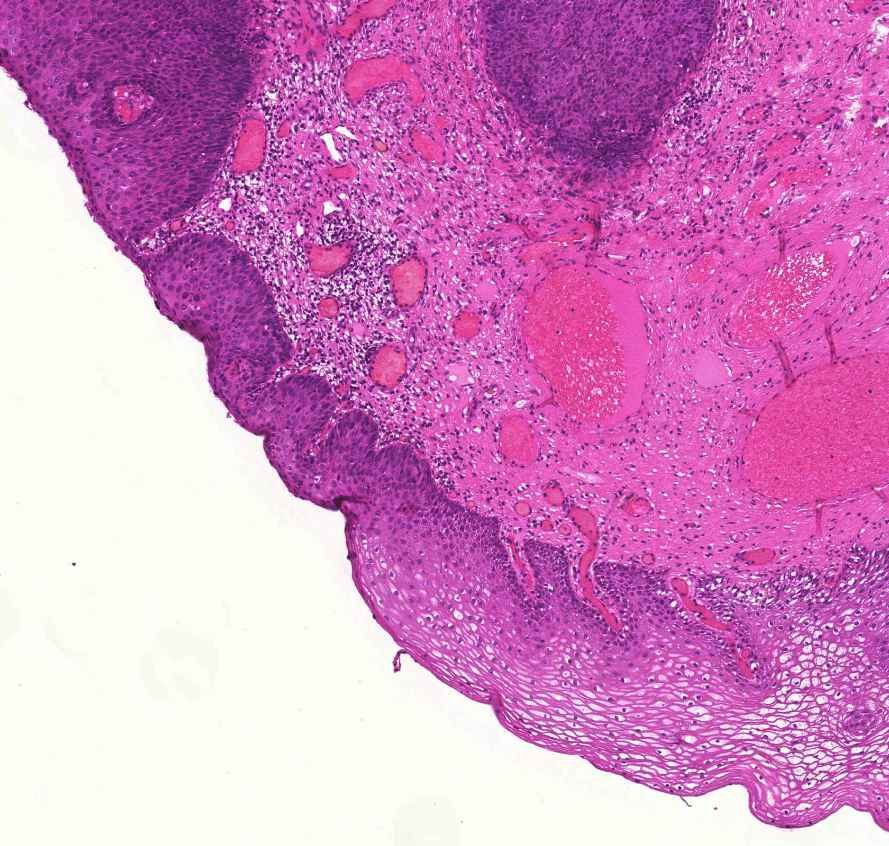 cervix in situ carcinoma 1