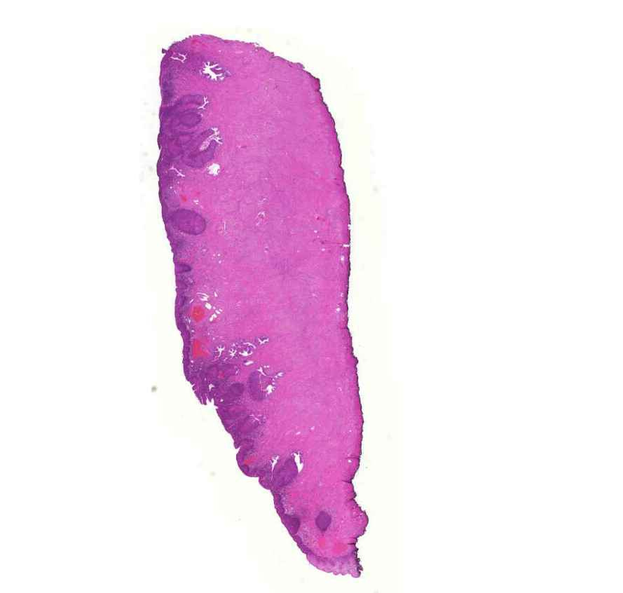 cervix in situ carcinoma