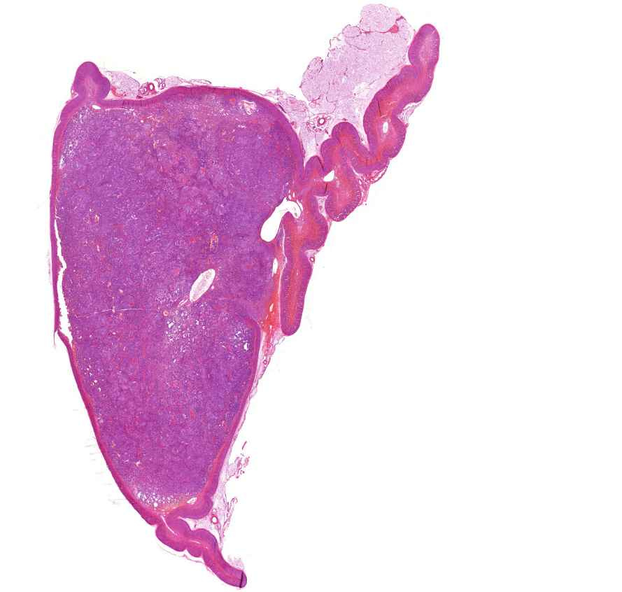 neuroblastoma