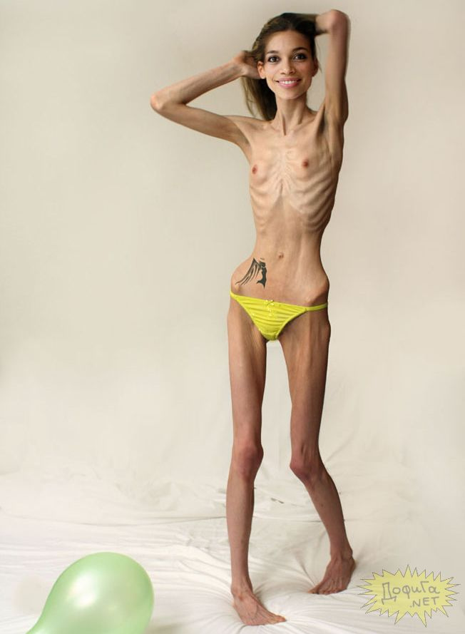 Anorexia